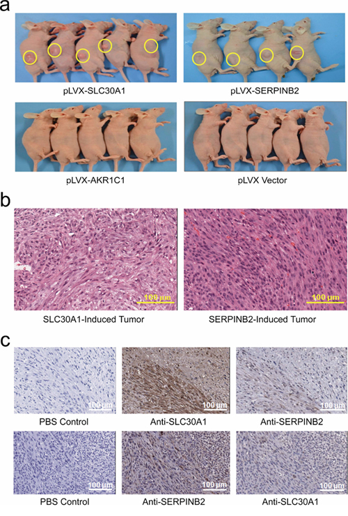 Xenograft tumor formation in nude mice of NIH3T3 cells ectopically and stably expressing SLC30A1, SERPINB2, AKR1C1, or vector control a. Histological analysis showed that all tumor cells had similar morphology and were diagnosed as fibrosarcoma b. Immunohistochemical staining c. demonstrated a high expression of SLC30A1 (up panel) or SERPINB2 (lower panel), respectively, in tumors induced by each of these two genes.