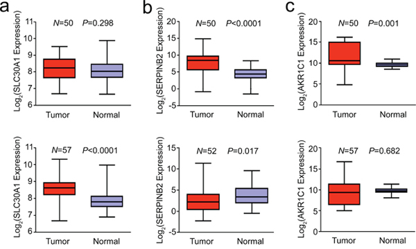 Aberrant expression of SLC30A1 a. SERPINB2 b. and AKR1C1 c. in human lung cancer and paired normal tissues (up panel, squamous cell carcinoma and lower panel, adenocarcinoma).