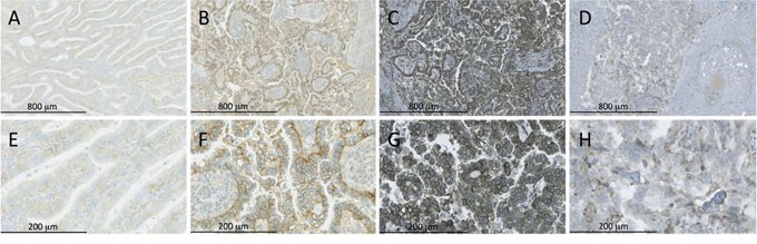 IGF-IR, PAPP-A and IGFBP-2 immunohistochemistry of ovarian tumors.