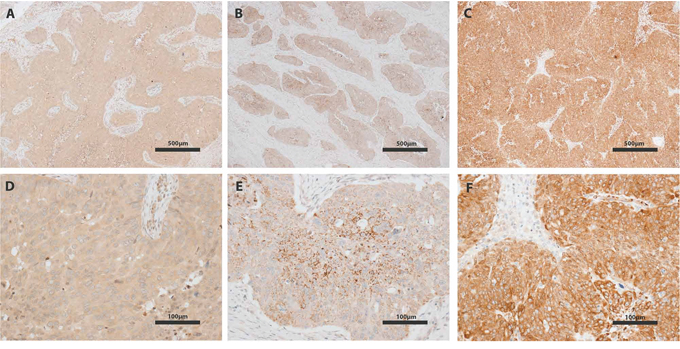 IGF-I, IGF-II and IGFBP-4 immunohistochemistry of ovarian tumors.