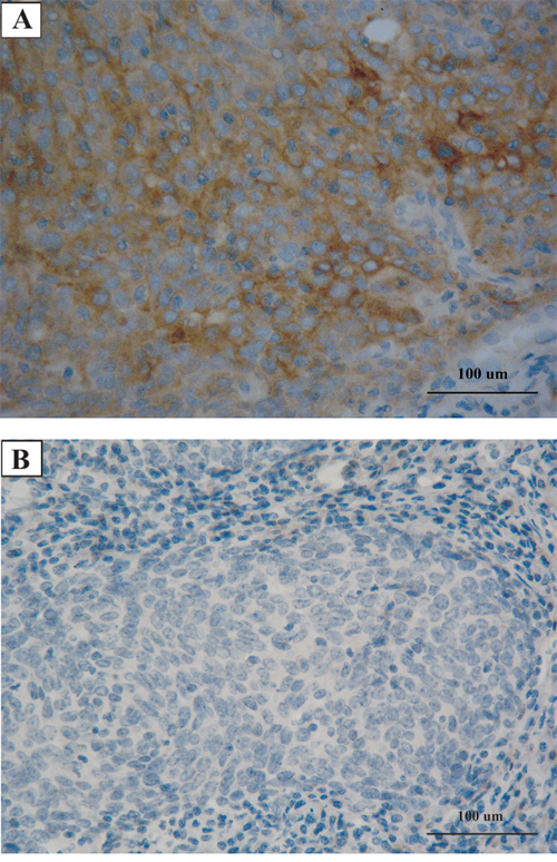Representatives of programmed cell death-ligand 1 (PD-L1) immunohistochemical staining in pulmonary lymphoepithelioma-like carcinoma.