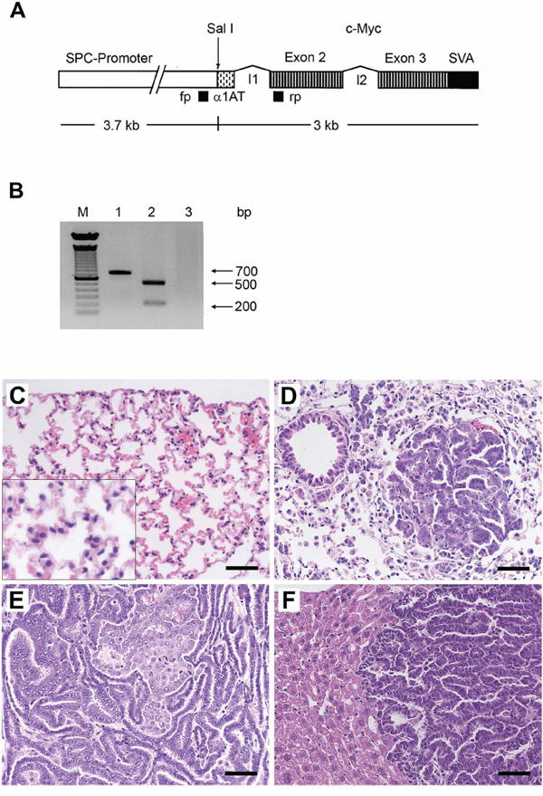 Histopathology of lung cancer and c-Myc transgene verification by PCR.