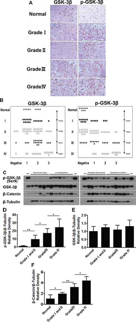 Human glioma tissues express high levels of p-GSK-3&#x03B2; (Ser9).