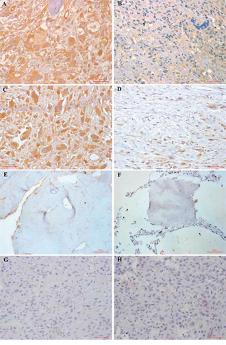 Immunohistochemical staining of FAK (A, B, E, G) and pFAK (C, D, F, H) proteins in osteosarcoma and normal cancellous bone tissues.
