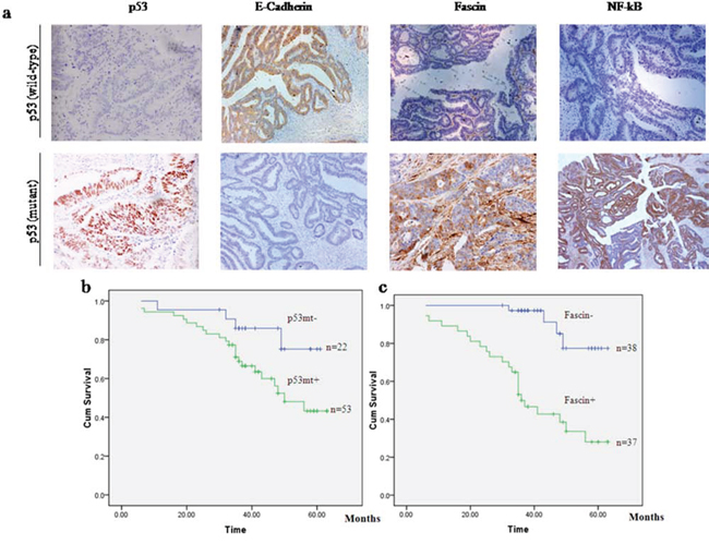 p53 mutation and Fascin expression are associated with poor clinical outcome in patients with colorectal adenocarcinomas.