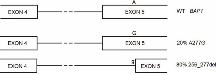 BAP1 A277G is a germline mutation that gives rise to two alternative splicing forms, one carrying the missense mutation, the other lacking of part of exon 5 and causing frameshift.