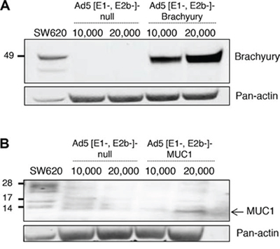 Expression of brachyury and MUC1 protein in human dendritic cells (DCs) infected with Ad5 [E1-, E2b-]- brachyury and Ad5 [E1-, E2b-]-MUC1.