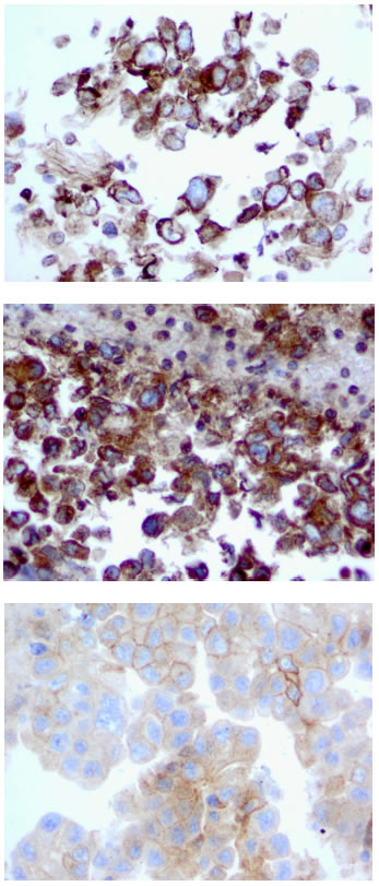 FRA Expression in Lung Adenocarcinoma FNA samples.