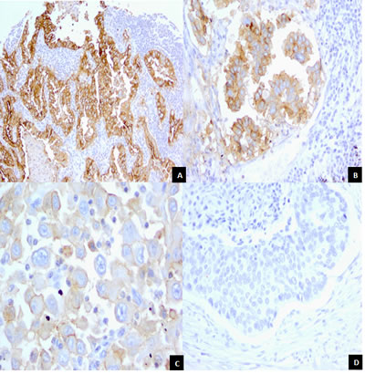 Staining Patterns and Intensities for FRA Expression in Lung Adenocarcinoma samples.