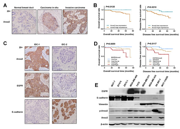 Elevated expression of Anxa2 is positively correlated with breast cancer metastasis and EMT markers.