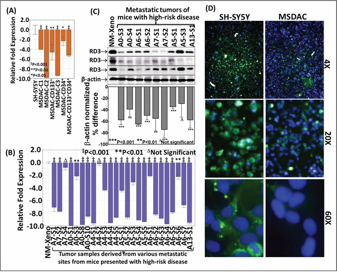 Transcriptional and translational loss of RD3 in high-risk aggressive neuroblastoma.