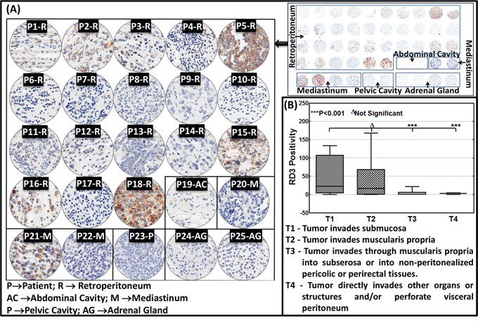 RD3 loss associates with the advanced tumor stage in neuroblastoma patients.