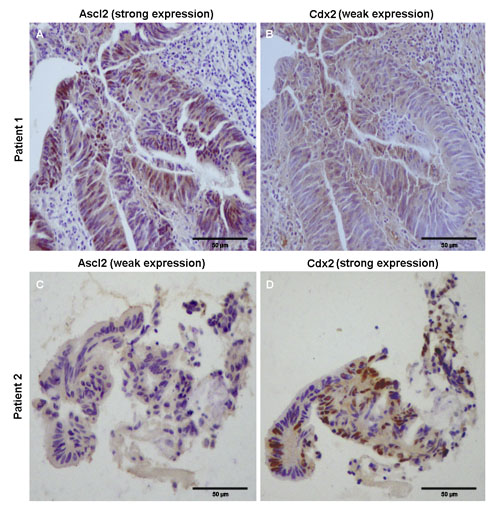 Immunohistochemical staining of Ascl2 and CDX2 proteins in cancerous tissues of colon cancer patients.