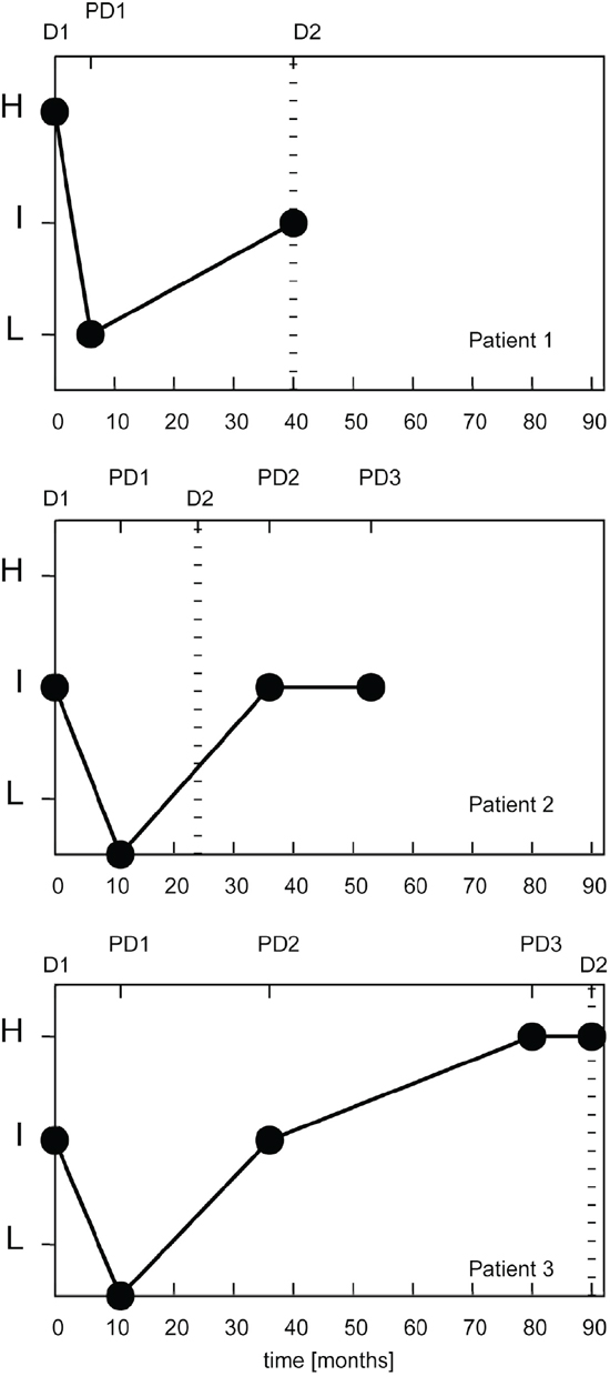 miRNA signature classifier risk profile (MSC) of 3 lung cancer patients with recurrent disease.