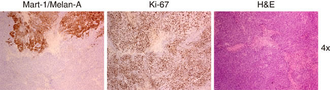 Representative images obtained from the same tumor area that is mainly negative for the expression of Mart-1/Melan A.