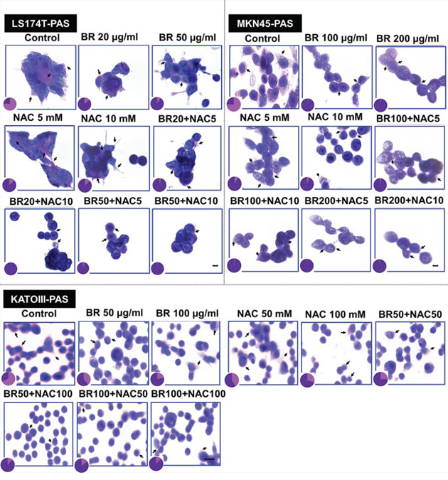 Periodic Acid-Schiff&#x2019;s (PAS) staining of gastrointestinal cancer cells.