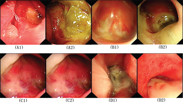 Nasopharyngeal images of recurrent nasopharyngeal carcinoma patients.