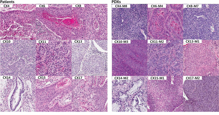 Histologic comparison between the patients and their PDX tumors.