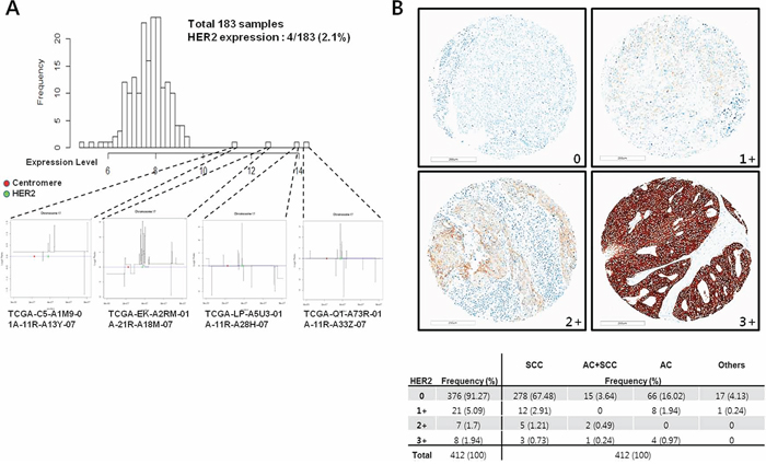 Incidence of HER2 expression in human cervical cancers.