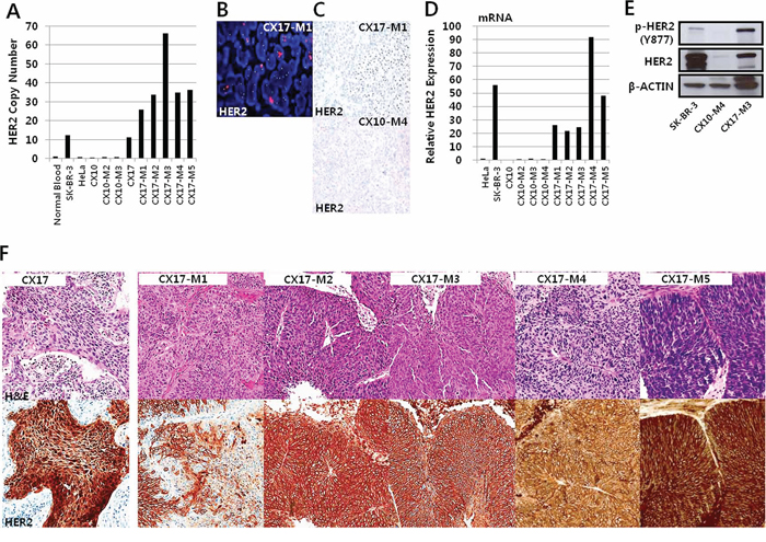 HER2 expression of CX17 PDX originating from the CX17 patient.