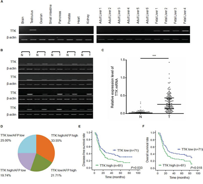 TTK expression patterns and clinical significance of TTK mRNA level in HCC specimens.