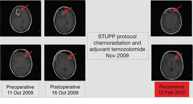 Radiological disease assessments relating to first-line treatment (surgical resection and STUPP protocol).