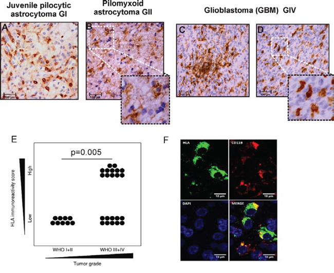 Detection of microglia/macrophages in low and high grade gliomas.