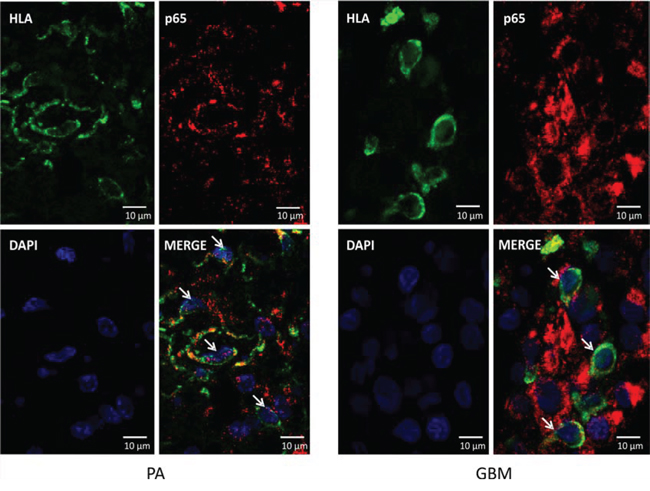 Localization of the nuclear p65 NF&#x03BA;B in glioma-infiltrating microglia/macrophages.