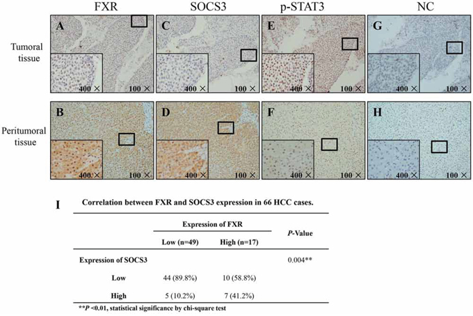 FXR and SOCS3 expression levels are positively correlated in human HCC specimens.