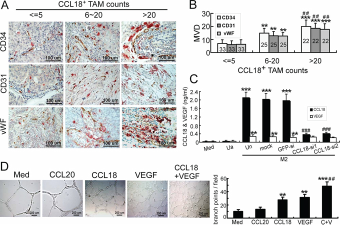 Correlation of CCL18 expression in breast TAMs with tumor MVD.