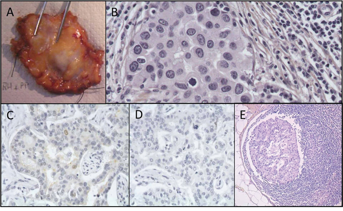 Histopathological features of the breast excision specimen.