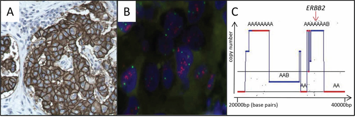 Confirmation of ERBB2 / HER2 amplification and overexpression.