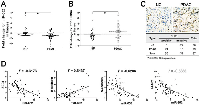 Deregulated miR-652-ZEB1 pathway in pancreatic cancer tissues.