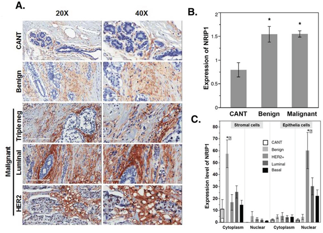 NRIP1 overexpression in human cancer tissue.