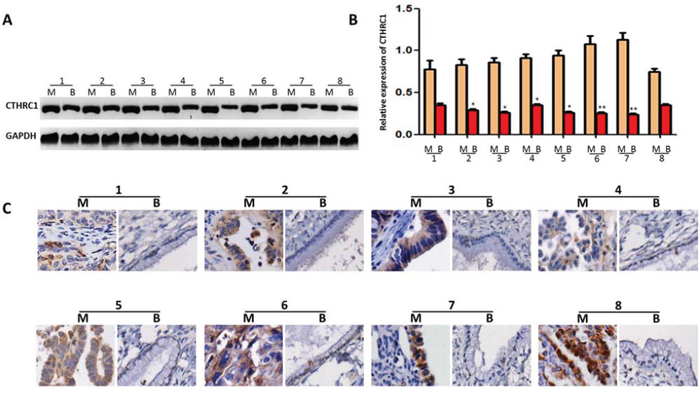 CTHRC1 expression in EOC tissues and adjacent ovarian benign tumor samples.