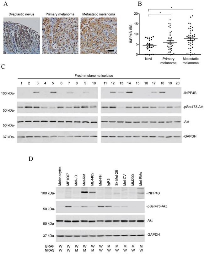 INPP4B is commonly upregulated in melanomas.