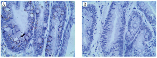 Expression of AQP3 in gastric intestinal metaplasia (GIM).