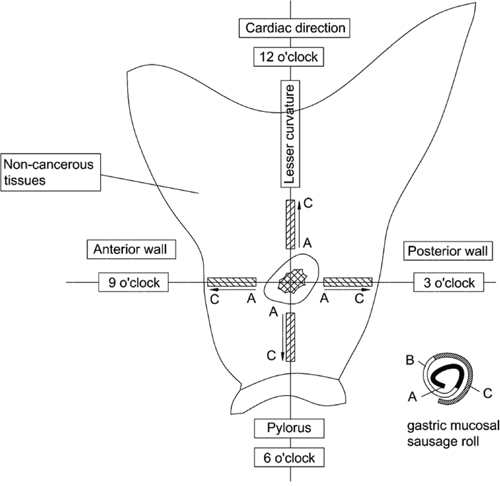 Diagrammatic sketch for &#x201C;gastric mucosal sausage roll&#x201D; technique.