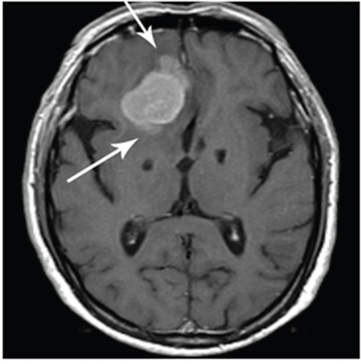 Brain invasion as noted by loss of fat plane (arrows) between tumor and normal brain.