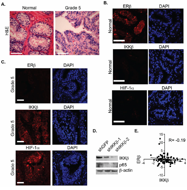 Analysis of ER&#x03B2;, HIF-1&#x03B1; and IKK&#x03B2; expression in prostate tissues.