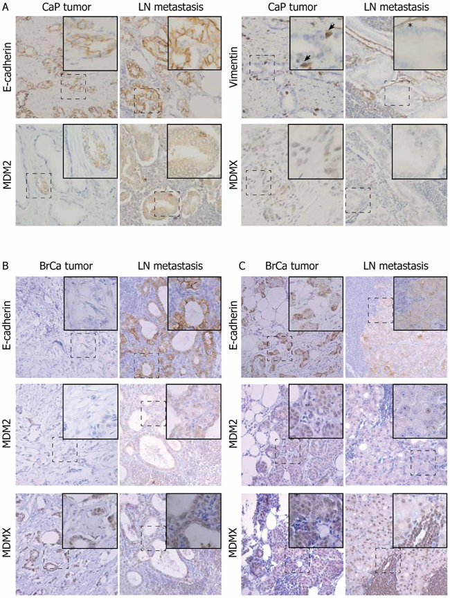 Changes in MDM2 and MDMX protein expression correlate with EMT in a proportion of paired patient prostate and breast tumors and metastases.