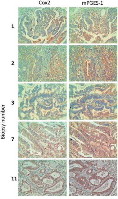 COX2 and mPGES1 expression in human colorectal tumor biopsies.