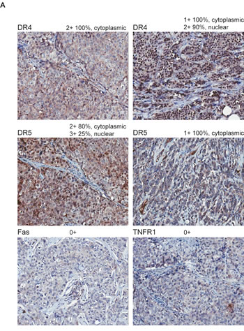 Immunohistochemical staining of DRs in primary breast tumors.