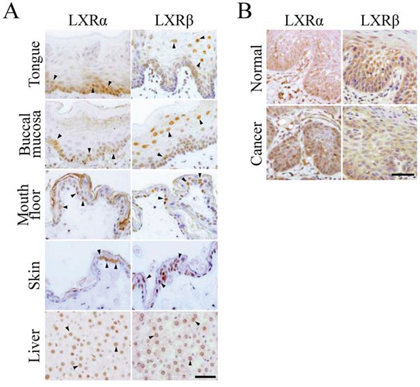 Expression of LXR&#x03B1; and LXR&#x03B2; in normal epithelia and squamous cell carcinoma tissues of the oral cavity.