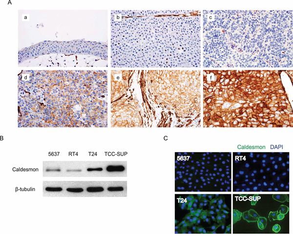 Protein expression of caldesmon (CAD) in human bladder cancer (BC) tissues and cell lines.