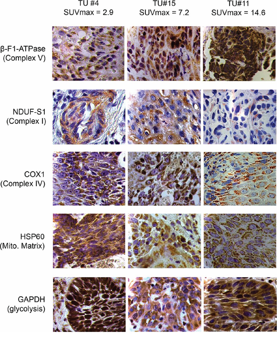 Representative immunohistochemical stainings of three HNSCCs for marker proteins quantified in this study.