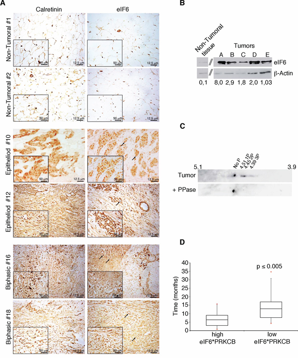 eIF6 expression and phoshorylation correlate to lower MPM patients survival.