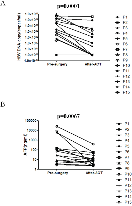 The impact of autologous TIL infusion on HBV load A. and AFP level B. Plasma samples taken prior to the surgery and after T cell infusion were assessed for HBV load and AFP level.