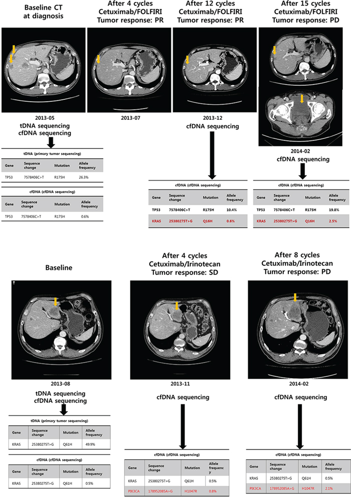 Patient monitoring with cfDNA during cetuximab-based treatment in metastatic colon cancer A. acquired resistance to cetuximab; B. primary resistance to cetuximab.