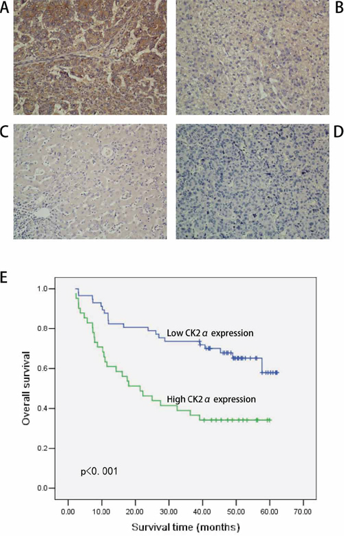 IHC analyses of CK2&#x03B1; protein expression in primary HCC surgical specimens and Kaplan&#x2013;Meier survival analyses of the primary HCC patients (n = 98).